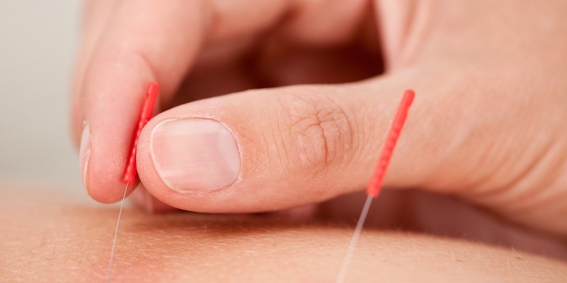 Acupuncture