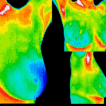 Breast Thermography